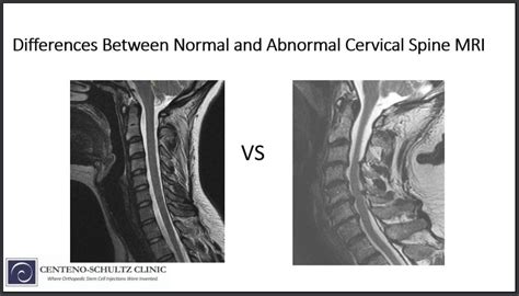 Normal vs Abnormal Cervical Spine MRI .